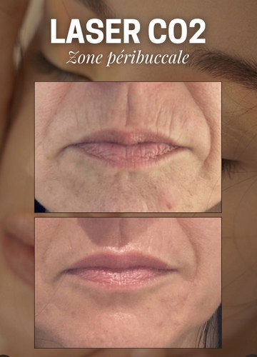 Traitement des rides péribuccales, Charbonnières-les-Bains, Docteur LE GUILLOUZIC Solenne