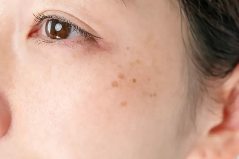 Traitement au laser pour tâche rubis, Charbonnières-les-Bains, Docteur LE GUILLOUZIC Solenne