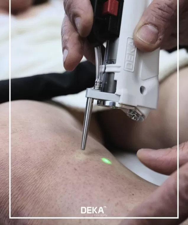 Epilation définitive au laser , Charbonnières-les-Bains, Docteur LE GUILLOUZIC Solenne