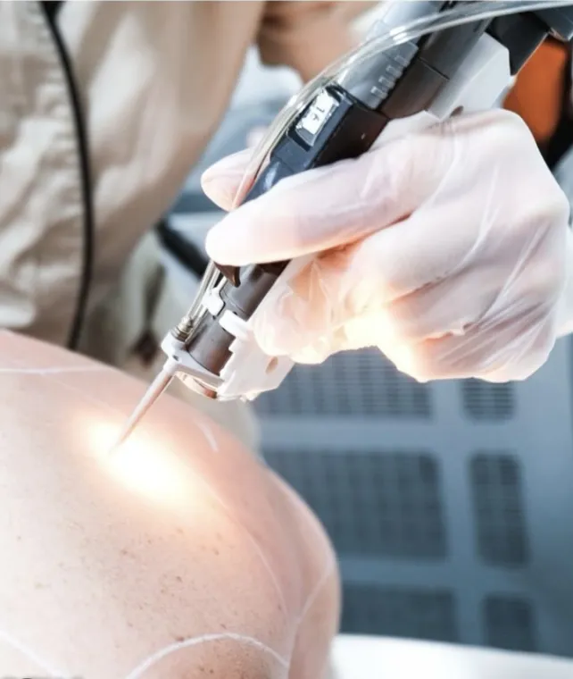 Pourquoi faut-il mieux réaliser l'épilation laser avec un médecin ?, Charbonnières-les-Bains, Docteur LE GUILLOUZIC Solenne