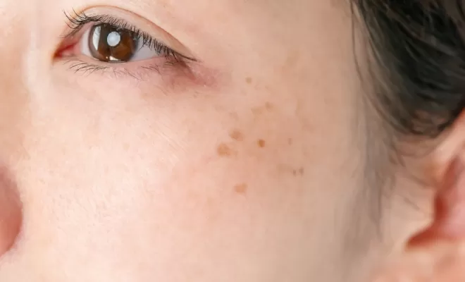 Traitement au laser pour tâche rubis, Charbonnières-les-Bains, Docteur LE GUILLOUZIC Solenne